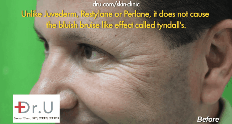 The patient wants to remove crow's feet wrinkles that appeared when he smiled and when his face was resting.*