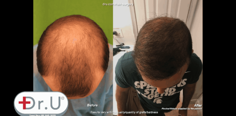Patient is shown before his Dr.UGraft ™ hair transplant at age 23