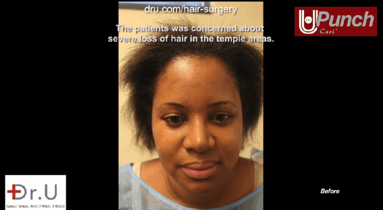Santa Monica patient hopes to achieve traction alopecia regrowth from her Dr.UPunch Curl hair transplant surgery