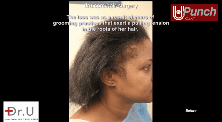 Side view of patient showing thinning edges and temples before her bald edges treatment with the Dr.UPunch Curl