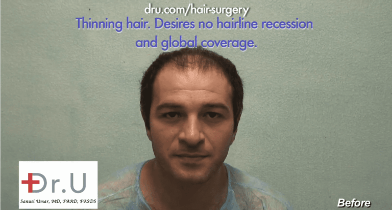patient with diffuse hair loss before his 10,000 grafts hair transplant with Dr.UGraft