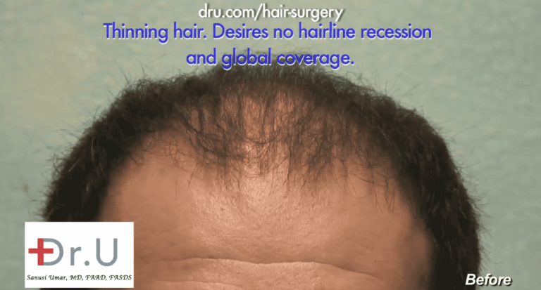 Beverly Hills patient hopes to achieve a low hairline to overcome recession