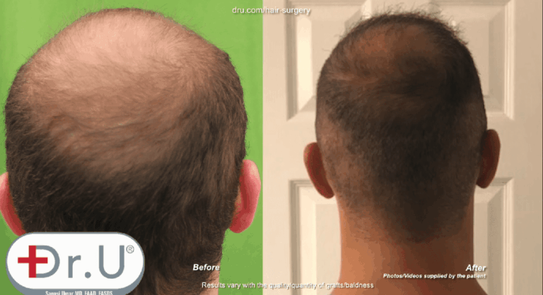 Patient was able to fill in his crown as a result of his Dr.UGraft early 20's hair transplant