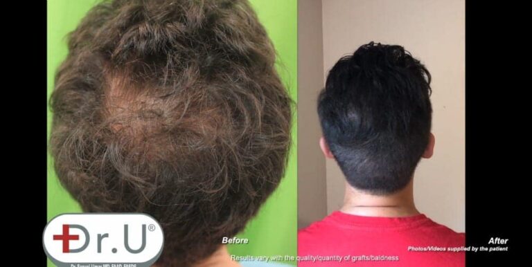 Patient's vertex hair transplant results show a natural looking fuller crown, with no obvious signs of hair loss