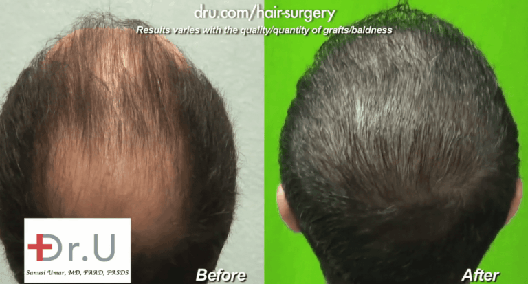 The Dr.UGraft's thinning hair transplant results shown in the crown and top of the scalp
