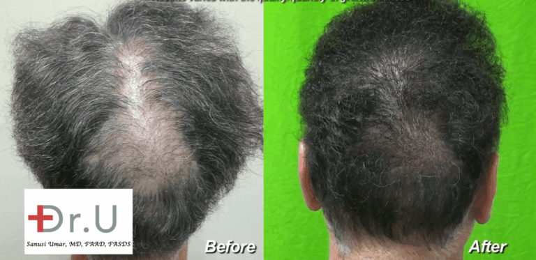 Beard hair grafts fill in crown slot from scalp reduction to produce seamless looking results
