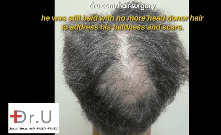 Additional donor resources are needed to fill in crown slot from scalp reduction 