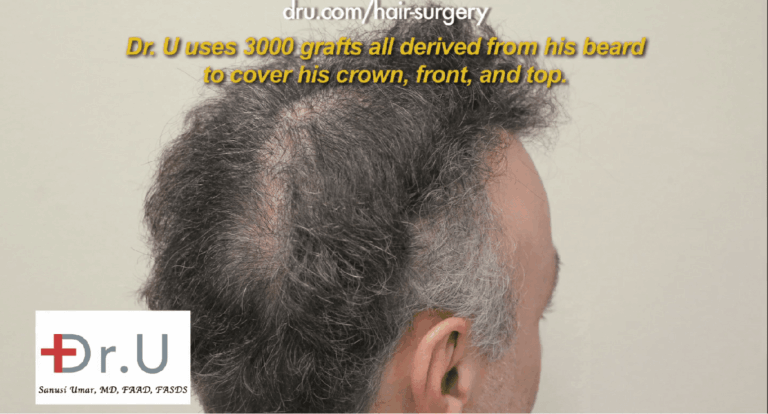 This patient required a slot deformity repair using additional donor grafts derived from non-head hair areas