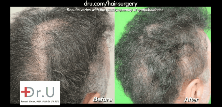 Pasadena patient before and after his Dr.UGraft scalp reduction repair 