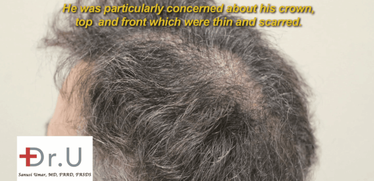 Patient no longer has enough head hair to fulfill the needs of his crown slot repair case.