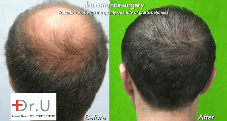 Image of the patient's crown hair transplant before and after 