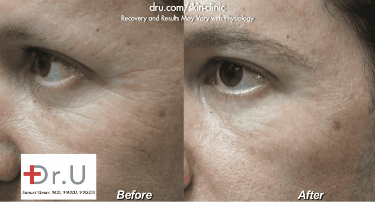 Belotero filler for crows feet produced a natural-looking reduction in the depth and number of fine lines at the corner of his eyes *