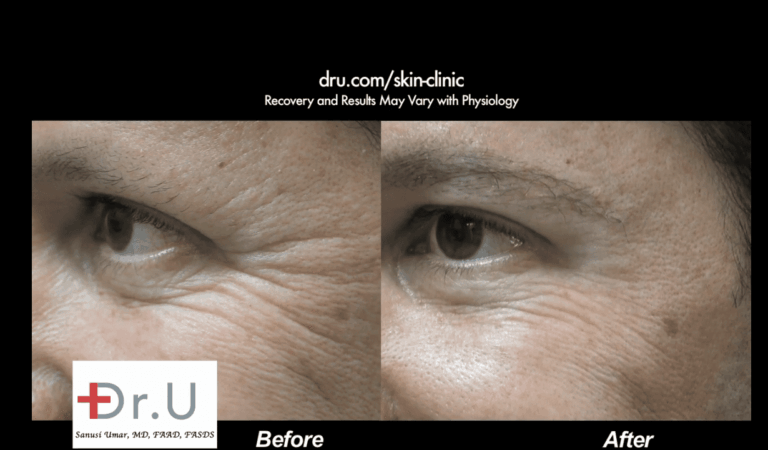 Patient's Belotero filler before and after pictures showing a drastic reduction in the depth of his crow's feet wrinkles *