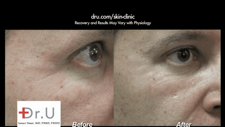 Venice Beach patient before and after his treatment with Belotero to remove crows feet *