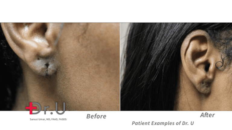 This Hollywood, Los Angeles patient approached Dr. Umar about her torn earlobe; after the repair procedure at Dr. U Skin Clinic, she was interested in safe earrings for split earlobes.