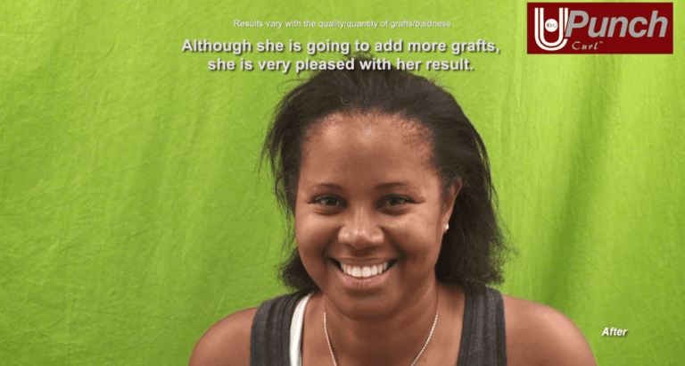 Santa Monica patient is now a firm believer that the Dr.UPunch Curl™ offers the best treatment for traction alopecia