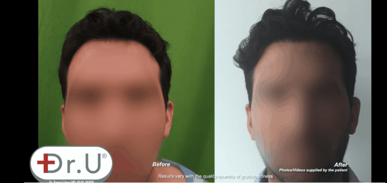 Patient achieved far more than just a hair transplant scar cover-up, but a whole new appearance that he can feel confident about