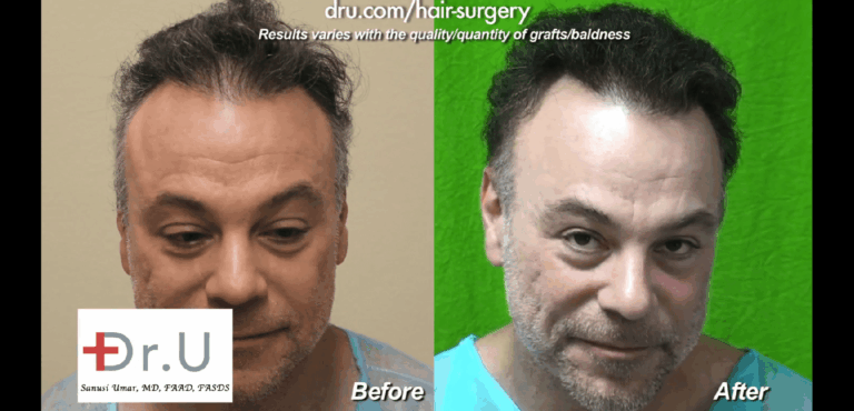 This patient finally found an ideal means to repair a crown slot from scalp reduction surgery which gave him a very natural looking outcome in the end