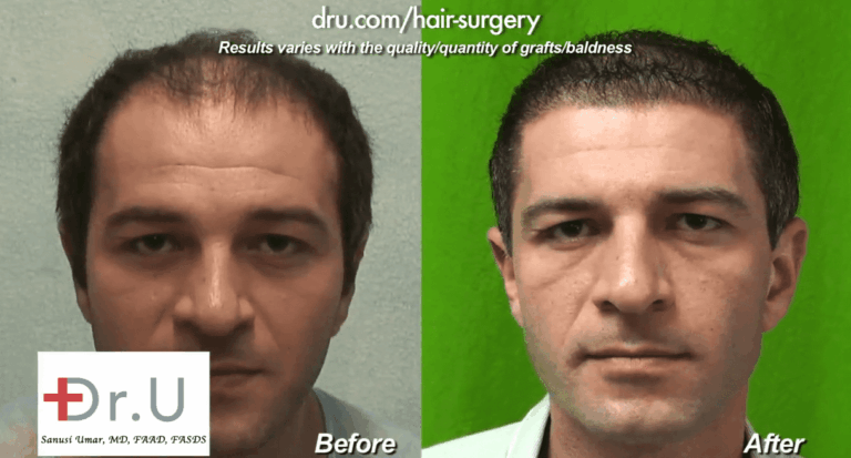 The Dr.UGraft's thinning hair transplant results shown in the crown and top of the scalp