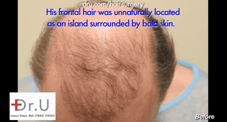 Patient's pluggy hair transplant results produced a triangle-shaped region on top of the head.