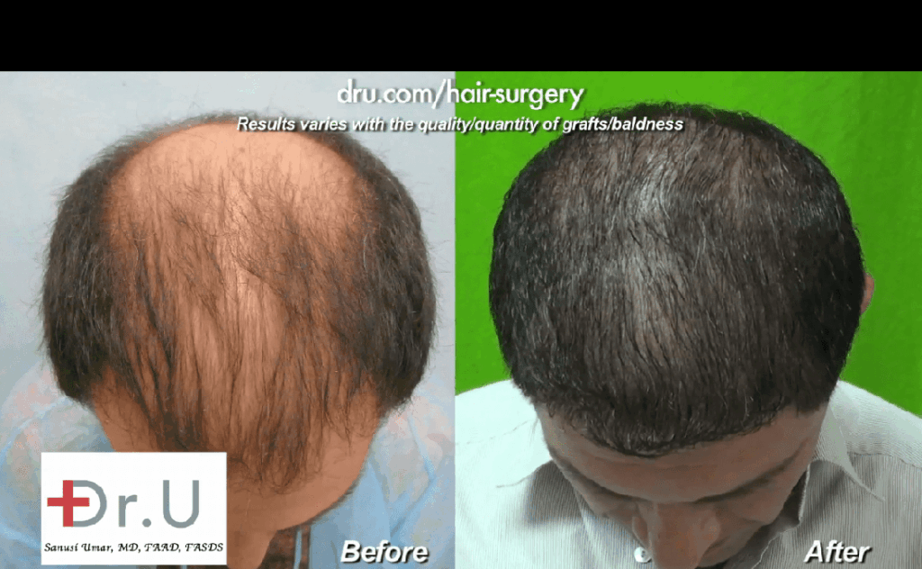 Before and after photos of thinning hair transplant results shown on patient's top scalp