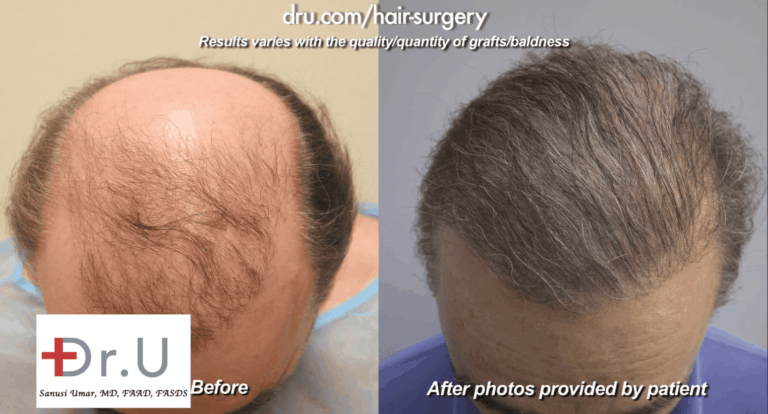 Beard hair was an effective resource to address the effect of no growth after hair transplant surgery