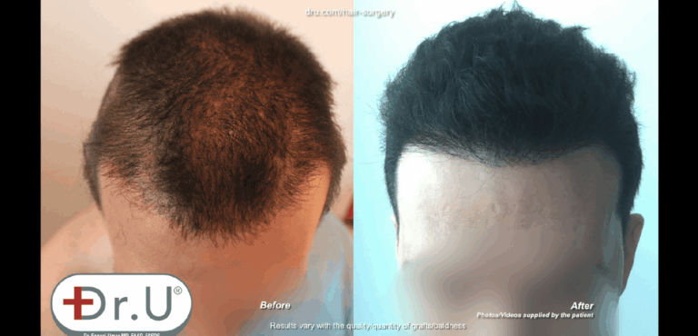 Patient from Venice Beach, Los Angeles now has normal looking hair growth patterns on the top of his head