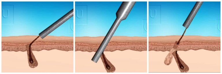 Body hair offers an effective solution to the problem of donor depletion after hair transplant surgery. But regular FUE punches are not able to follow the angle of these hairs and incur the risk of cutting straight through the grafts