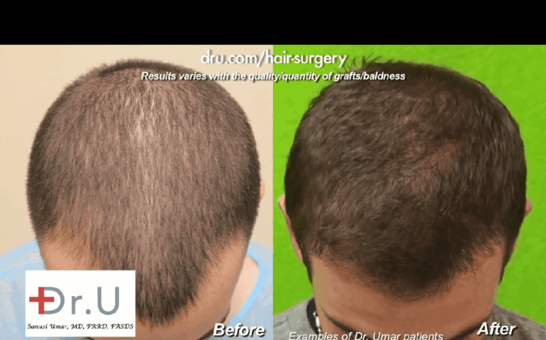 Final hair transplant results will not happen right away. Patients will need to undergo various stages of hair transplant growth before they reach their final outcome Final hair transplant results will not happen right away. Patients will need to undergo various stages of hair transplant growth before they reach their final outcome