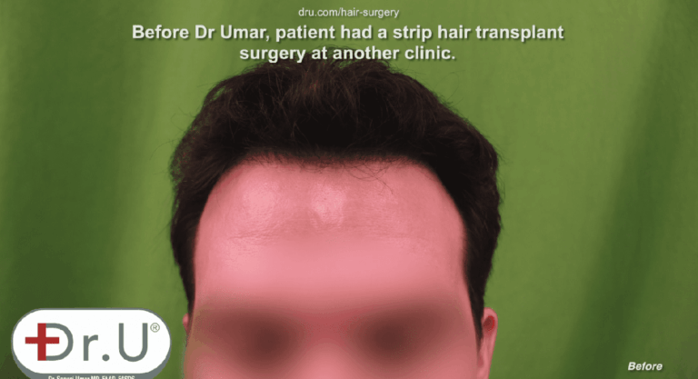 Venice Beach patient is unhappy with his receded hairline and temples