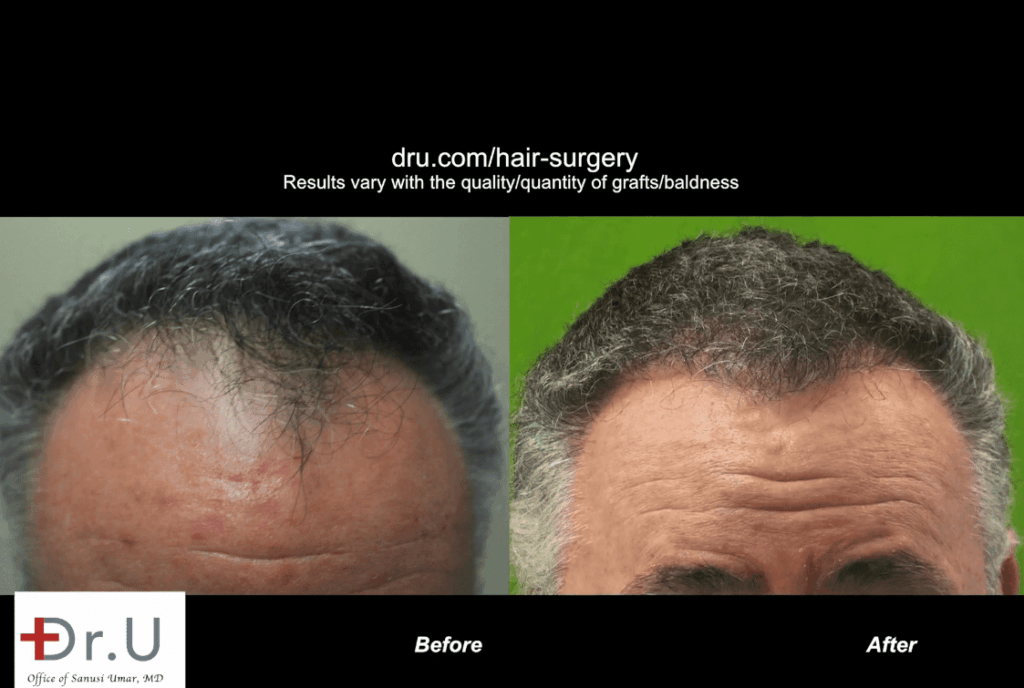 Patient is happy with his conservative hair transplant outcome which advanced his receded hairline and temples to produce a natural-looking improvement * Patient is happy with his conservative hair transplant outcome which advanced his receded hairline and temples to produce a natural-looking improvement *