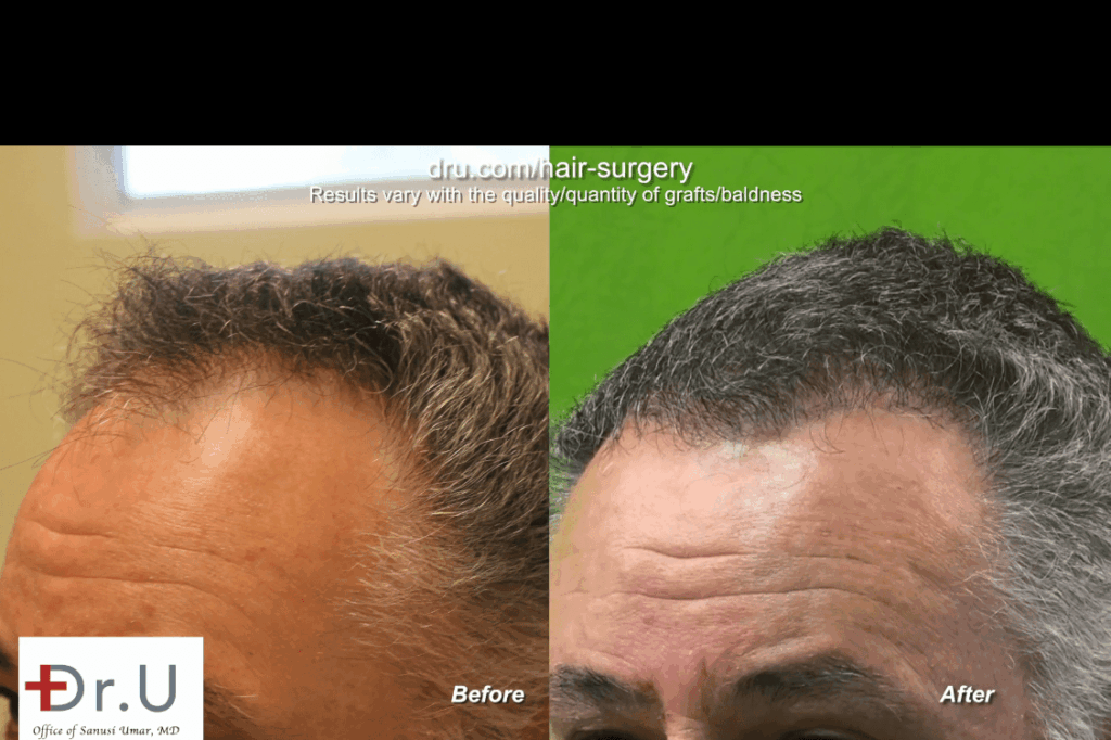 Closeup view of mature hairline and corresponding temple points, before and after surgery * Closeup view of mature hairline and corresponding temple points, before and after surgery *