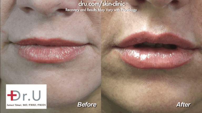 Patients often ask, how long do injectable fillers last? The answer often depends on the area that is injected and the individual's metabolism
