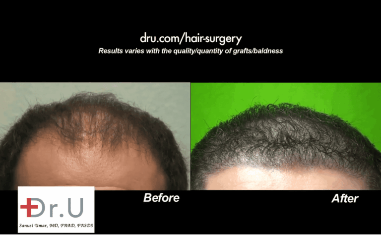 Beverly Hills patient was able to achieve an aggressive low hairline after his Dr.UGraft procedure