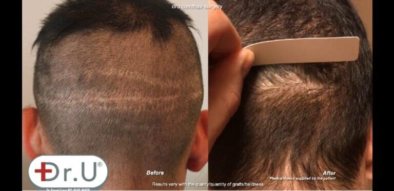 Close up view of the Dr.UGraft™ strip scar repair. No noticeable signs of scarring can be seen even as a piece of cardboard runs through the back of the head