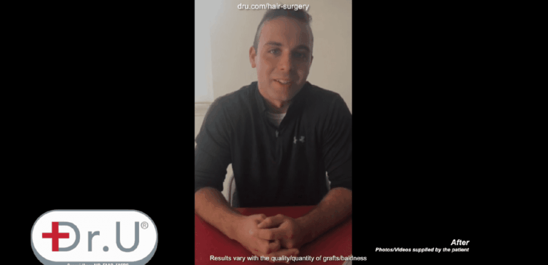 Manhattan Beach patient is happy with his decision to undergo an early 20's hair transplant with Dr.UGraft™ technology