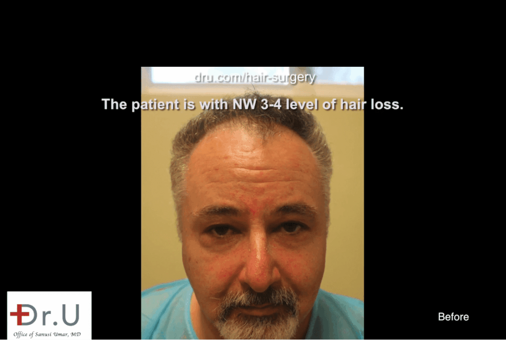 Redondo Beach patient before his Norwood 4 hair transplant* Redondo Beach patient before his Norwood 4 hair transplant*