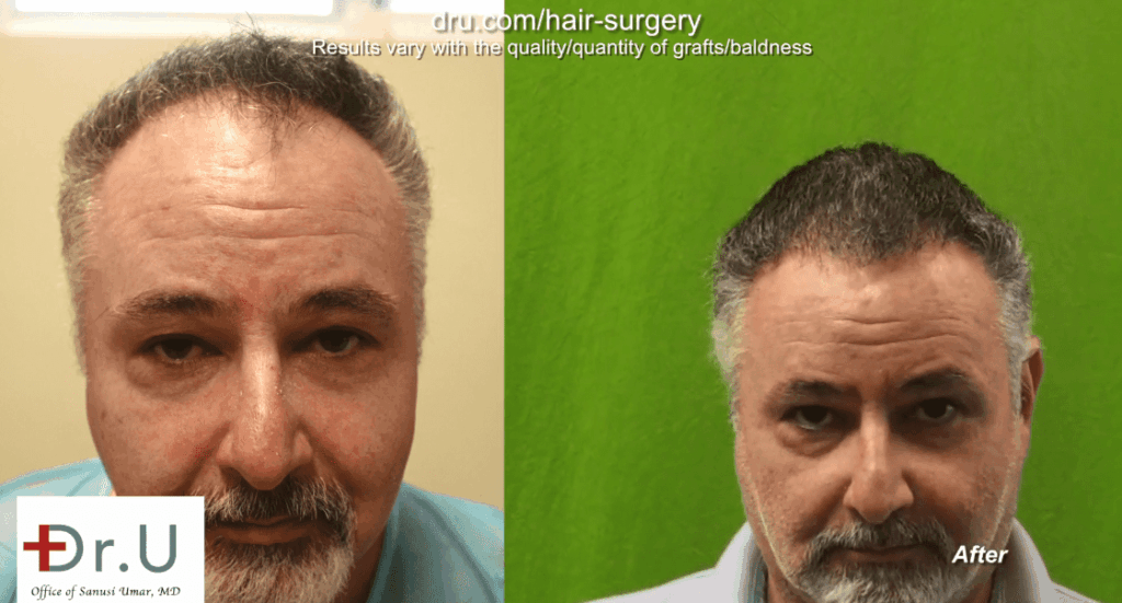 Patient is happy with the way his Norwood 4 hair transplant energized his overall appearance, while maintaining an age-appropriate look * Patient is happy with the way his Norwood 4 hair transplant energized his overall appearance, while maintaining an age-appropriate look *