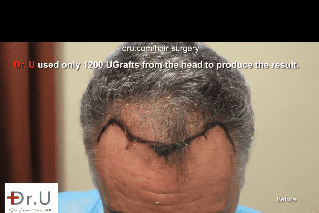 Dr. Umar designed a hairline and temples to create a most natural looking hair transplant outcome.* Dr. Umar designed a hairline and temples to create a most natural looking hair transplant outcome.*