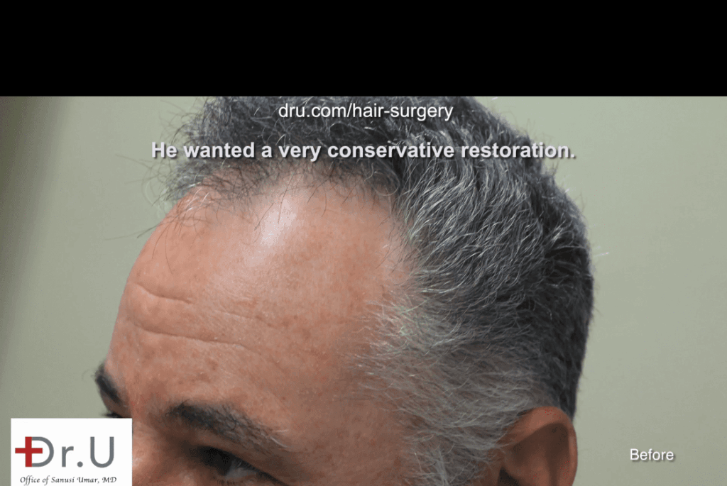Patient wants the look of a mature hairline that is appropriate for his age* Patient wants the look of a mature hairline that is appropriate for his age*