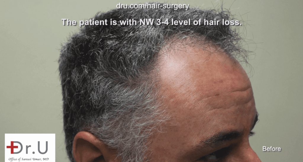 Side view of patient showing receded temples. He hopes to achieve a conservative hair transplant outcome* Side view of patient showing receded temples. He hopes to achieve a conservative hair transplant outcome*