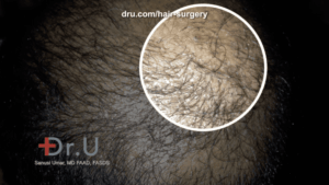 In the initial stages of hair transplant growth, around the third to fourth month, patients may start to notice pimple-like bumps, which actually is a positive sign of new growth In the initial stages of hair transplant growth, around the third to fourth month, patients may start to notice pimple-like bumps, which actually is a positive sign of new growth