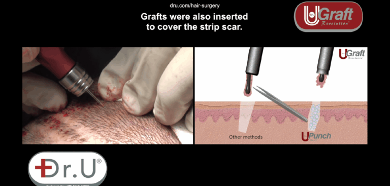Dr.UGraft™ flushes out grafts with fluid instead of relying on metal forceps to retrieve impacted grafts. This prevents mechanical injuries. 