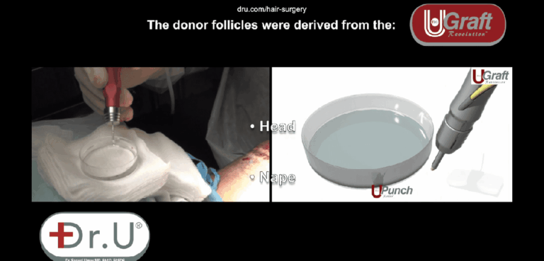 Dr.UGraft™ technology uses fluid irrigation to hydrate grafts right when they are being extracted to prevent them from being exposed to the air