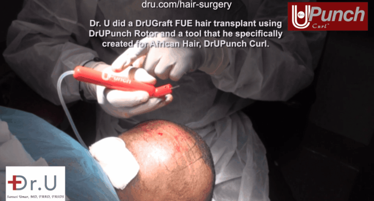 Dr. Umar performs a traction alopecia treatment on Santa Monica patient, using his device the Dr.UPunch Curl