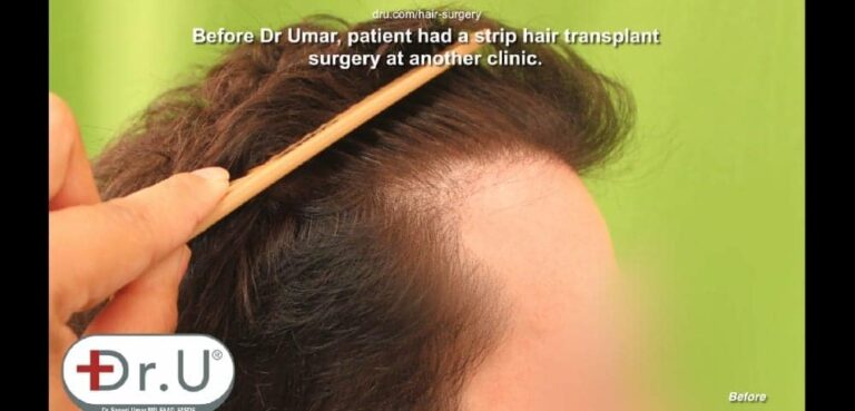Patient shows pluggy appearance along the edge of his hairline and temples