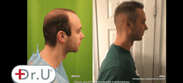 Before and after images depicting new temples, a conservative hairline and crown coverage due to the patient's Dr.UGraft™ hair transplant at age 23