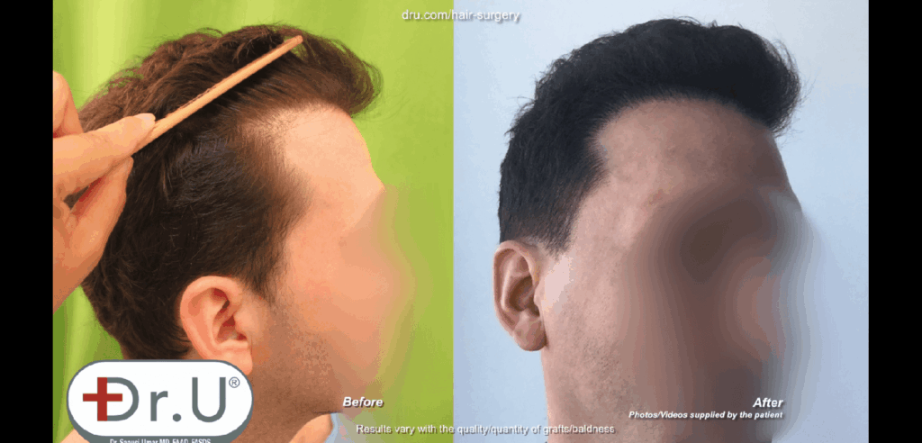 The Dr.UGraft solution for receding hairline helped turn the clock back for this patient, while producing very natural looking results 