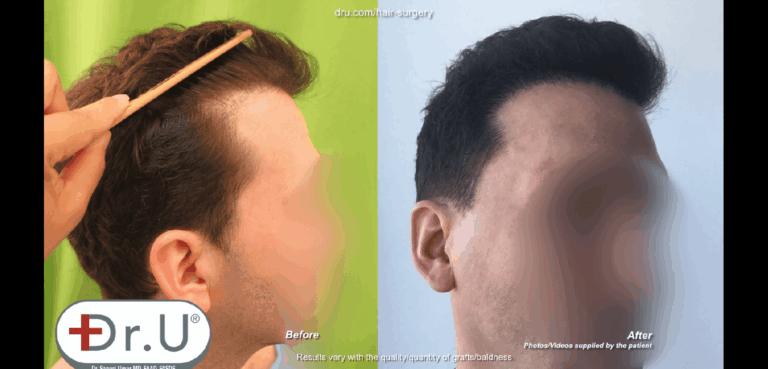 Dr. Umar was able to undo hair transplant mistakes from the patient's strip surgery to give him a more natural looking hairline and temples