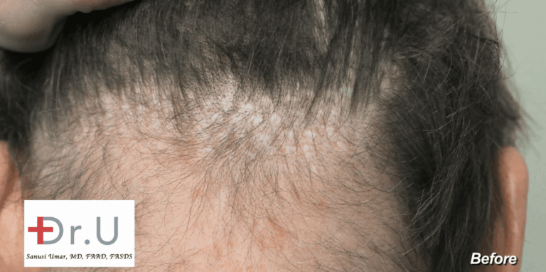 Photo of Newport Beach, Los Angeles patient showing overharvested donor area after hair transplant surgeries performed with 80's punch graft devices.